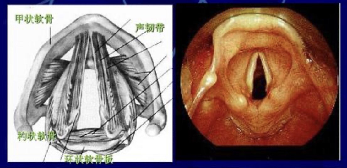 麻醉喉管图片图片