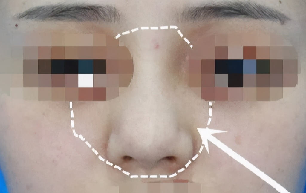 为什么注射隆鼻会导致鼻背越来越宽？