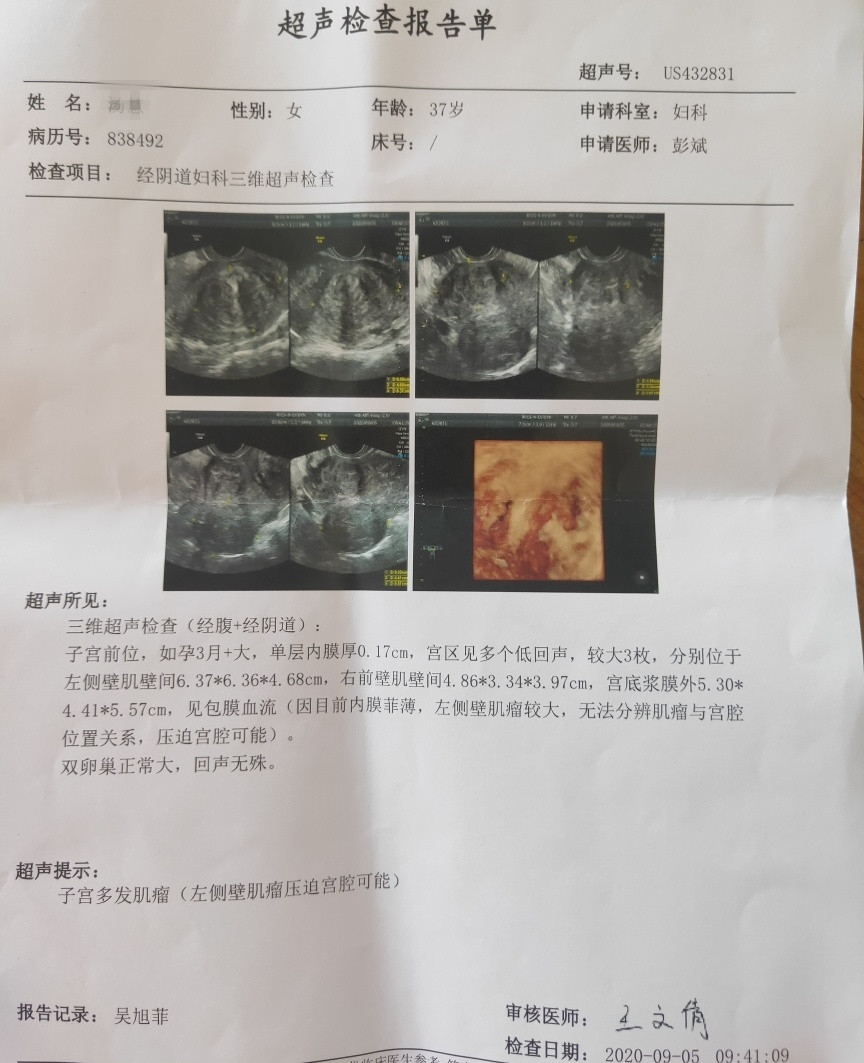 子宫肌瘤超声报告图片