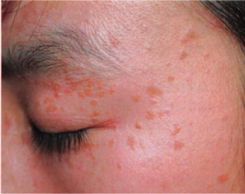 感染hpv皮肤有什么症状图片