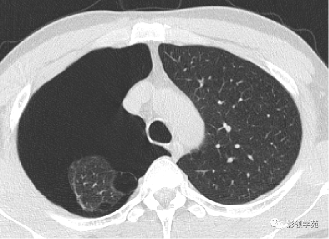 肺大泡ct表现图片图片