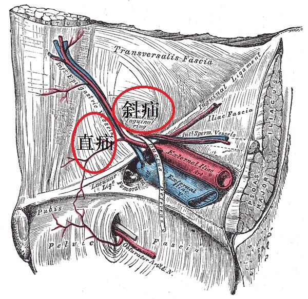 图2  腹股沟区域的解剖示意图