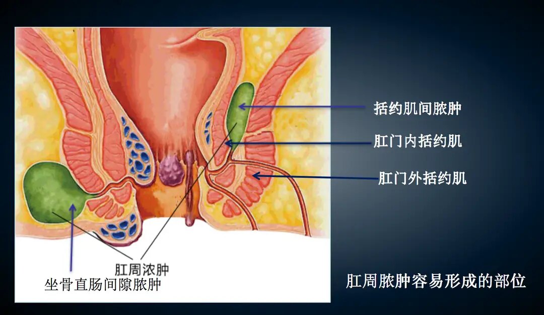 肛周脓肿手术3d演示图片
