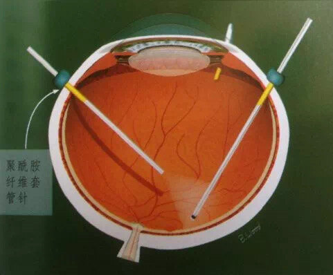 视网膜脱落打硅油图解图片