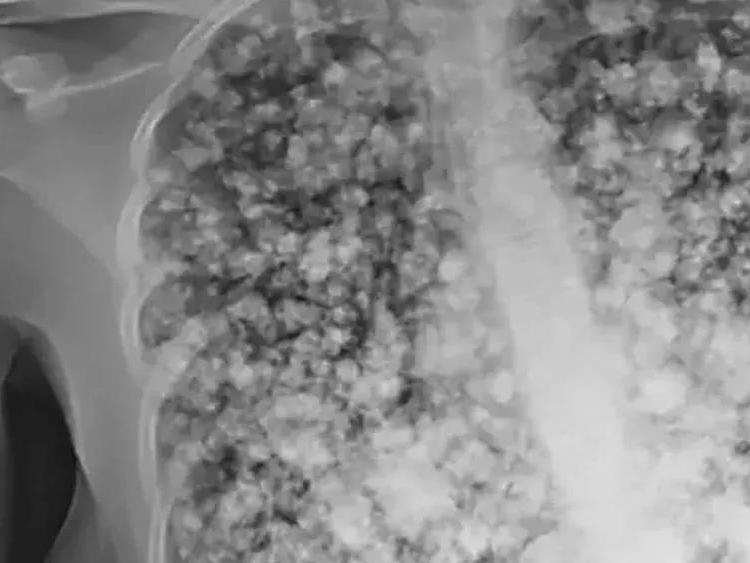 吸电子烟的肺图片