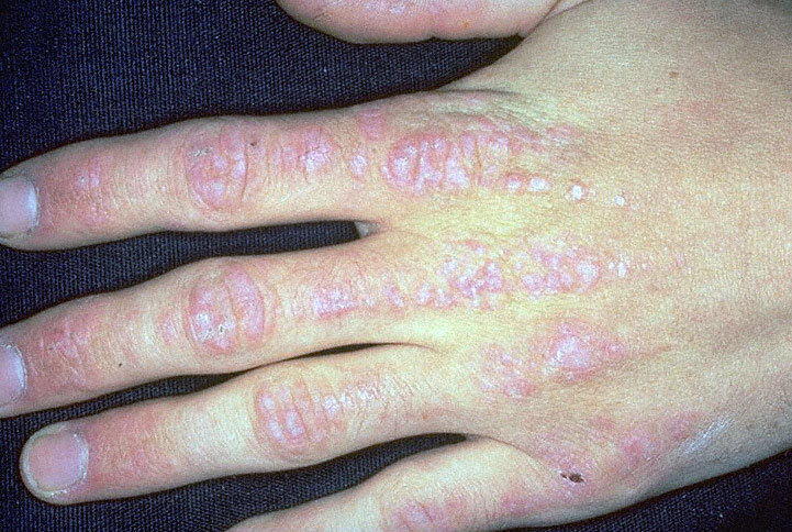 皮肌炎是什么病早期图片