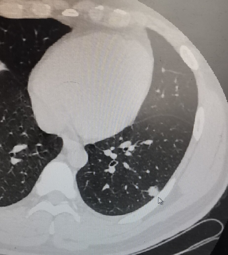 肺部实性结节图片