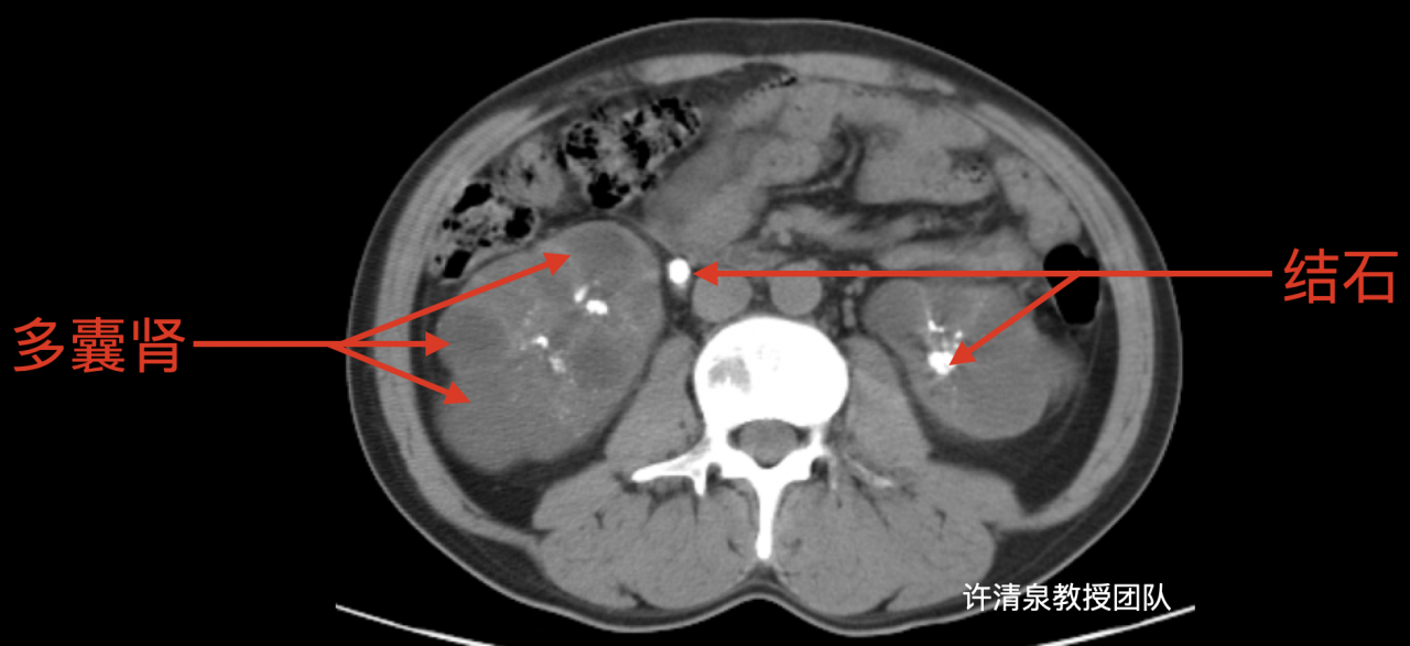 多囊肾CT图片