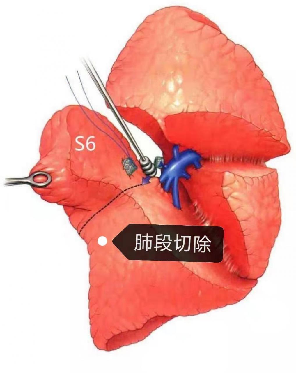 肺部常见手术方式——楔形切除,肺段切除,肺叶切除