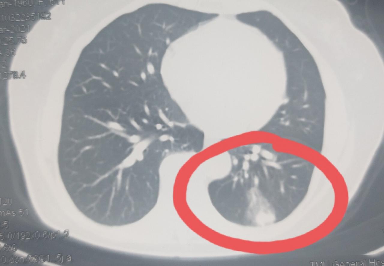 刘懿博士说肺癌（二二五亖）体检出肺有问题，不要非等两年再来切
